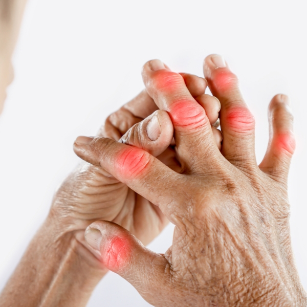 Rheumatoid Arthritis