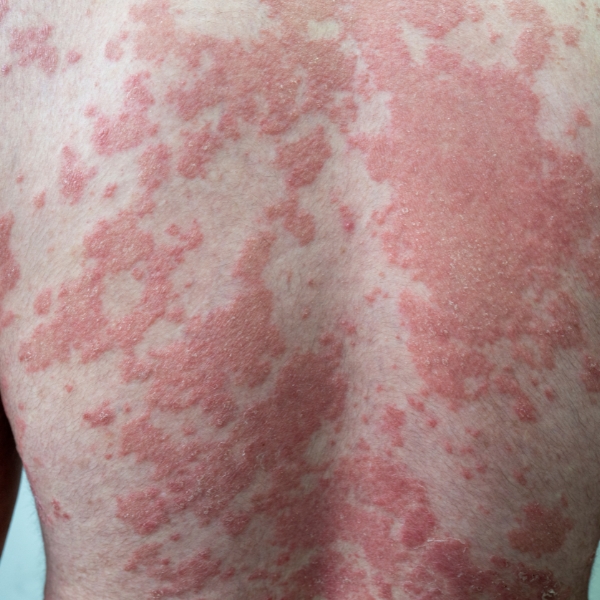 Psoriaisis