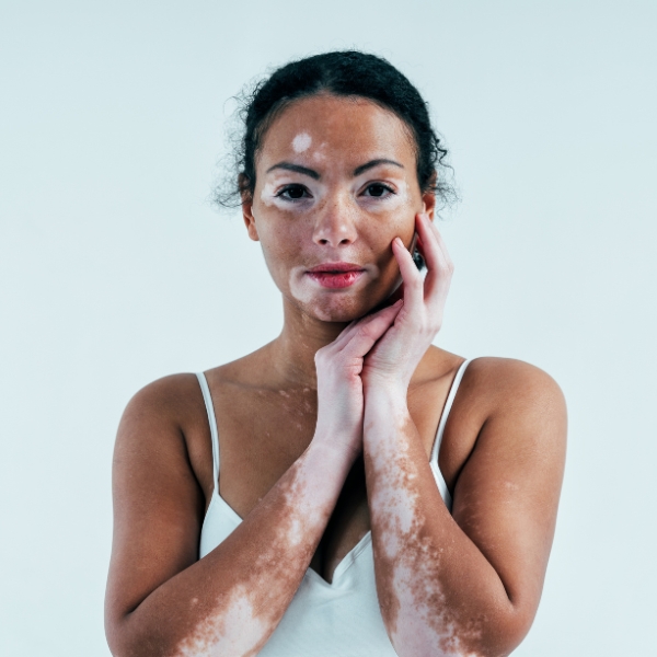 Vitiligo